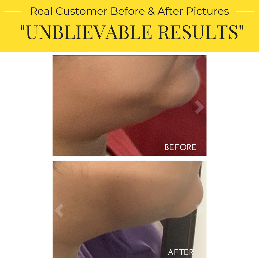 V-Line Lifting Chin Mask (5-masks)